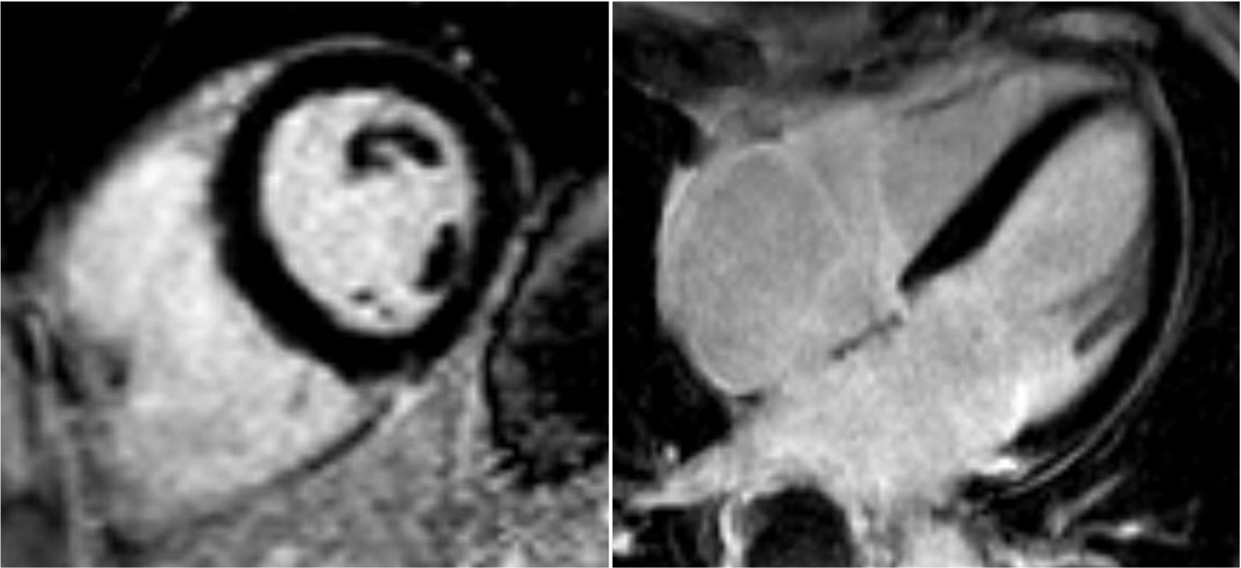 Kontrastmittelverstärkte Aufnahmen (Late Gadolinium Enhancement) eines gesunden Herzens ohne Infarktnarbe. Der Herzmuskel kommt schwarz zur Darstellung.