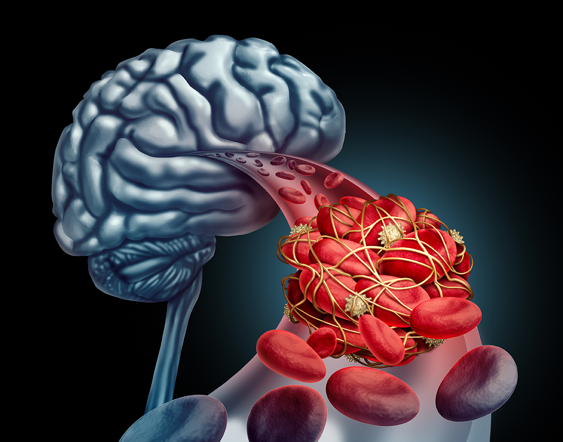 Hirnvenenthrombosen und Sinusvenenthrombosen nach COVID-19-Impfung