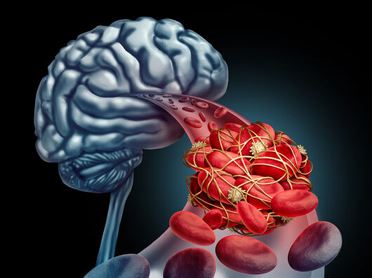 Hirnvenenthrombosen und Sinusvenenthrombosen nach COVID-19-Impfung