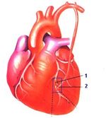 minimalinvasive Bypassoperation