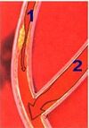 Wenig Blut fließt durch die verengte Stelle in der Herzkranzarterie (1). Durch Aufnähen eines Bypasses (2), die sogenannte Anastomose, wird eine gute Durchblutung hinter der Verengung sichergestellt