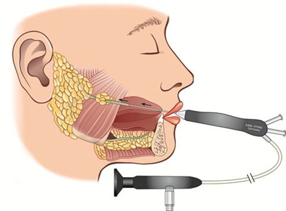 Schematische Darstellung einer Spiegelung des Ausführungsganges des Ohrspeicheldrüse