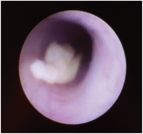Endoskopisches Bild eines Speichelsteines im Ausführungsgang der Unterkieferspeicheldrüse