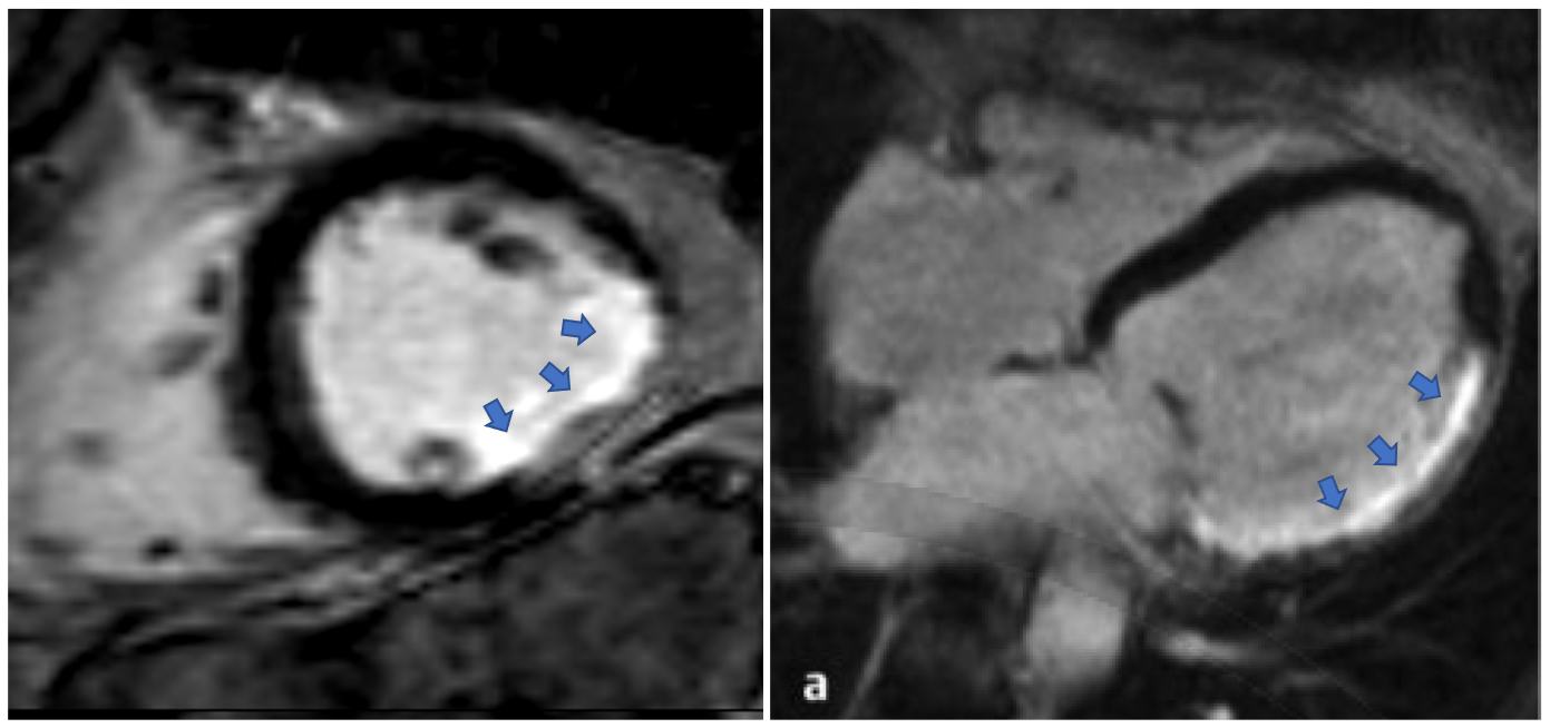 Kontrastmittelverstärkte Aufnahmen (Late Gadolinium Enhancement) eines Herzens mit Infarktnarbe. Die Infarktnarbe kommt weiß zur Darstellung (blaue Pfeile) und hebt sich deutlich vom schwarz dargestellten Herzmuskel ab.