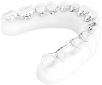 Das Bild zeigt ein Zahnmodell mit einer lingualen Zahnspange. Diese Art von Zahnspange ist auf der Innenseite der Zähne angebracht – also zur Zunge hin. Die Spange besteht aus Metallbrackets und Drähten, die zur Korrektur und Ausrichtung der Zähne dienen