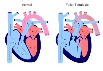 Fallot-Tetralogie