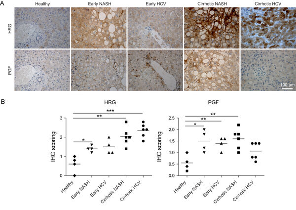 Figure 5: Connections between hepatic macrophage and endothelial cell signaling in human liver. The placental growth factor (PGF) reflects angiogenic activation of the endothelial cells. Modidied from earlier previous study.4 