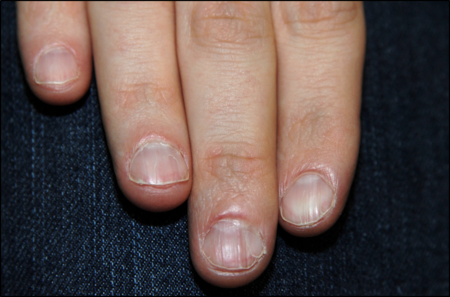 Nageldystrophie bei einem Patienten mit Dyskeratosis congenita