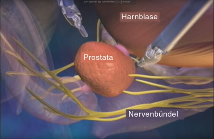 prostatakarzinom op adenom decum să tratezi